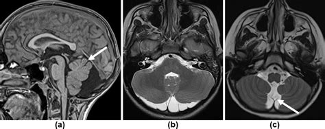 prominent retrocerebellar csf space|posterior fossa cystic mass.